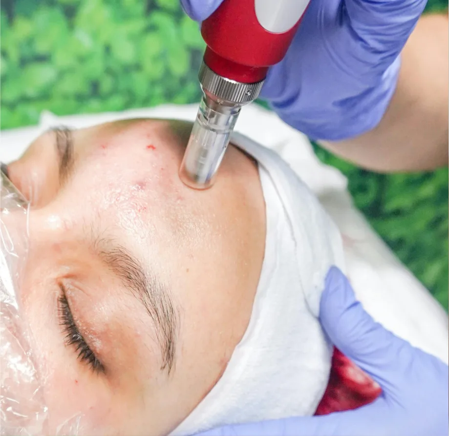 A microneedling handpiece drawn across a patient's forehead